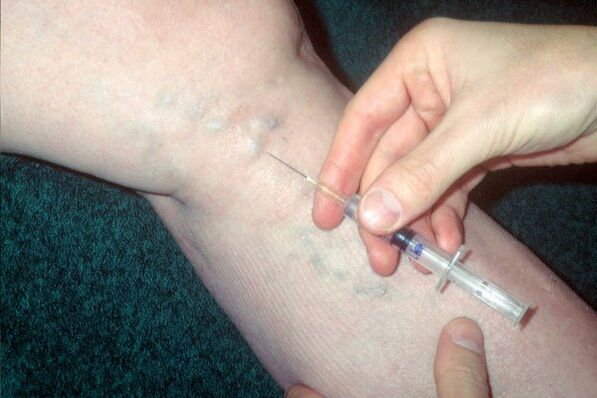 Escleroterapia para varices