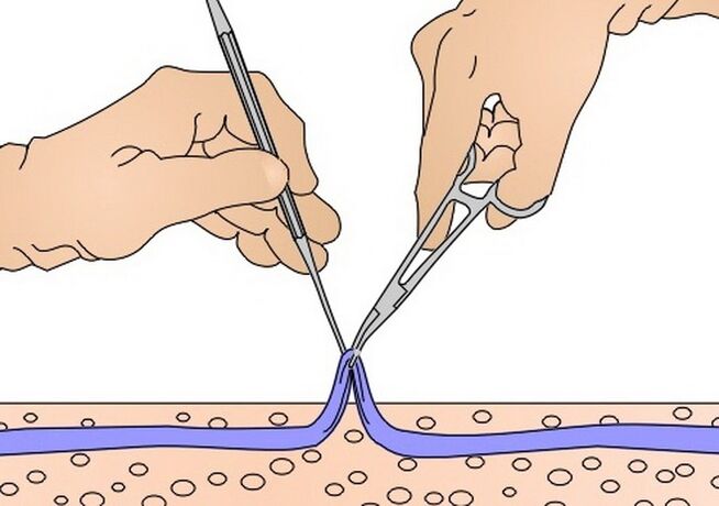 Decapado de venas para varices