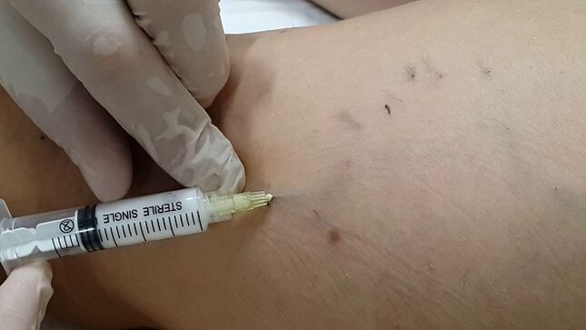 Escleroterapia para varices