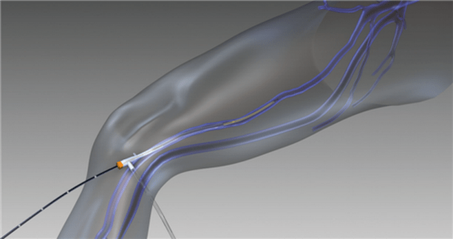 Obteración por radiofrecuencia para varices