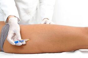 Escleroterapia como método para tratar varices