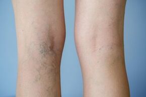 Varices nas pernas