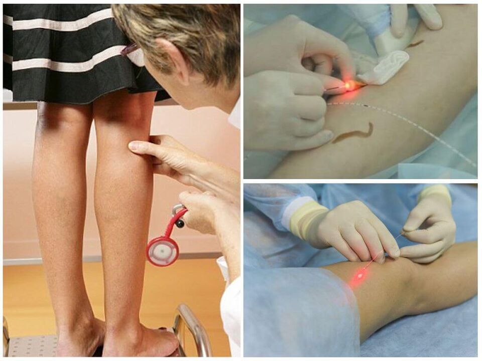 Avance do procedemento de coagulación con láser para varices nas pernas