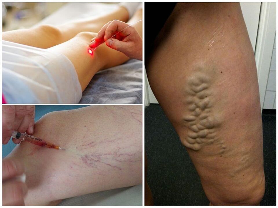 Métodos de tratamento non cirúrxico das varices das pernas