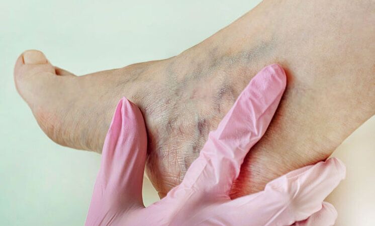 Varices nas pernas